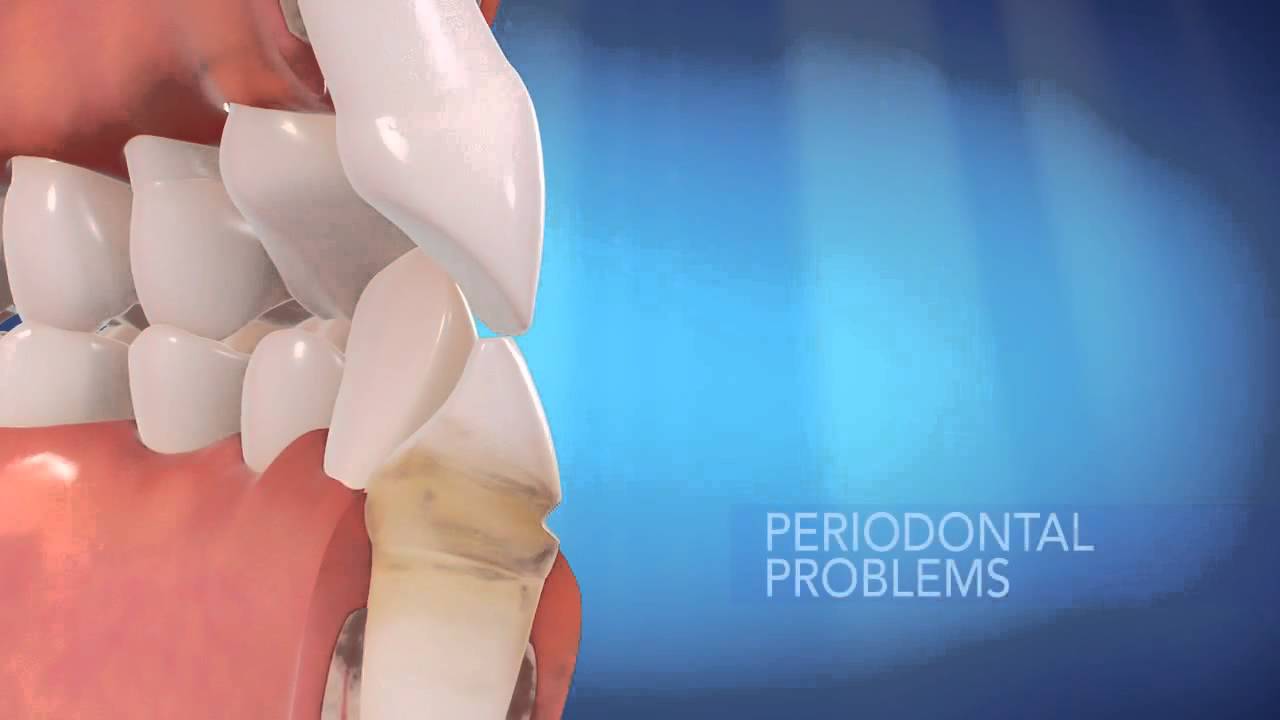 Northridge Invisalign Cosmetic Dentist Balboa Smiles 818-894-6161