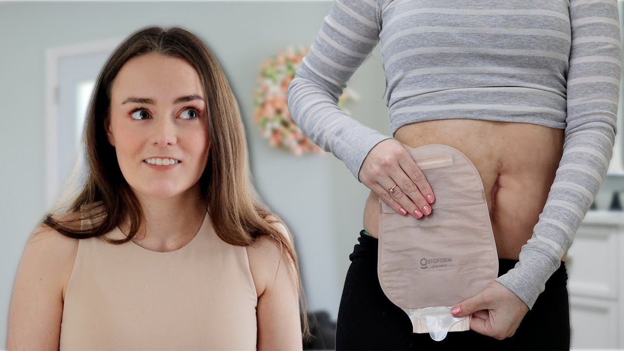 An Ostomy Appliance with the MOST Unique Feature! | Let's Talk IBD