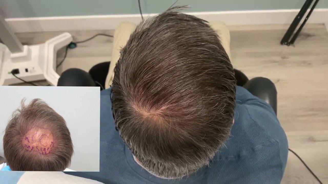 Crown Hair restoration with 2500 grafts FUE