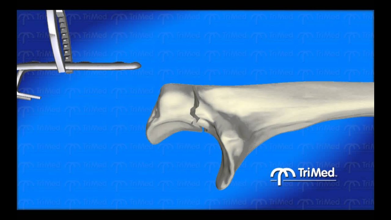 Olecranon Hook Plate Animated Demo