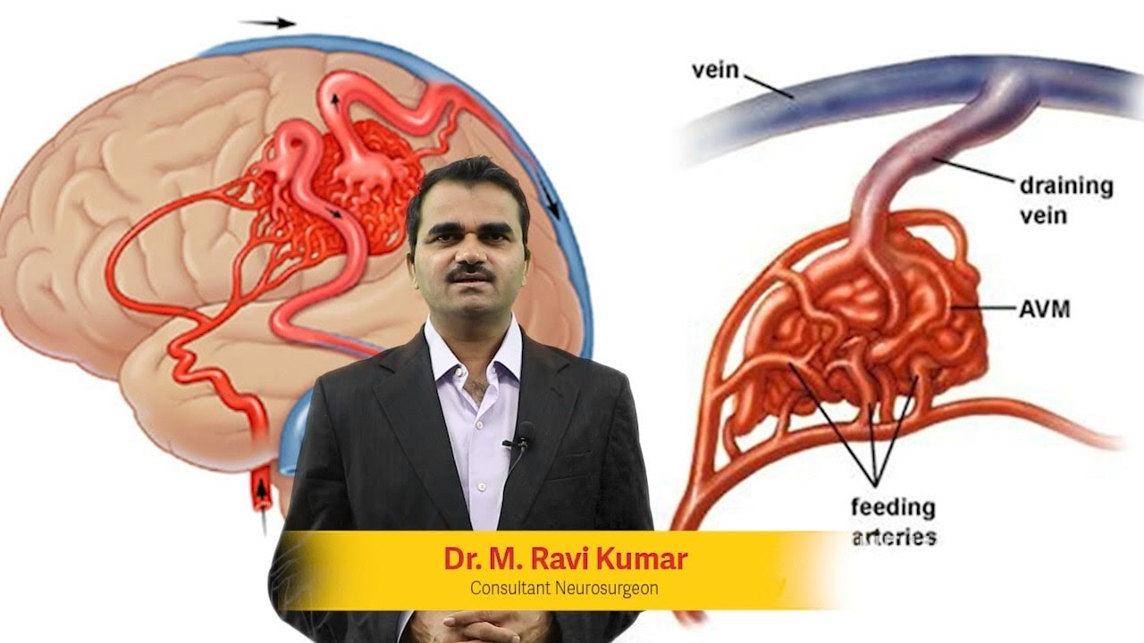 Arteriovenous Malformation (AVM) explained by Dr. M. Ravikumar | Consultant Neurosurgeon