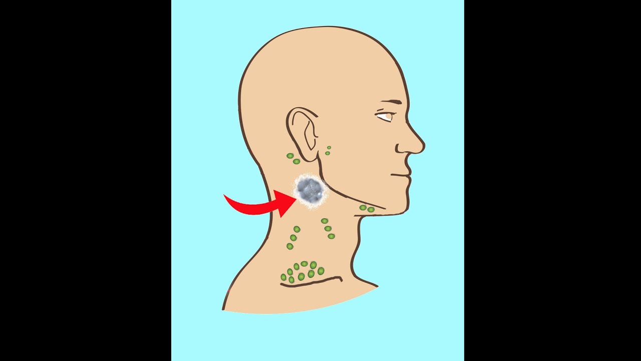 تضخم الغدد الليمفاوية الخطير/ السرطانى وأسبابه