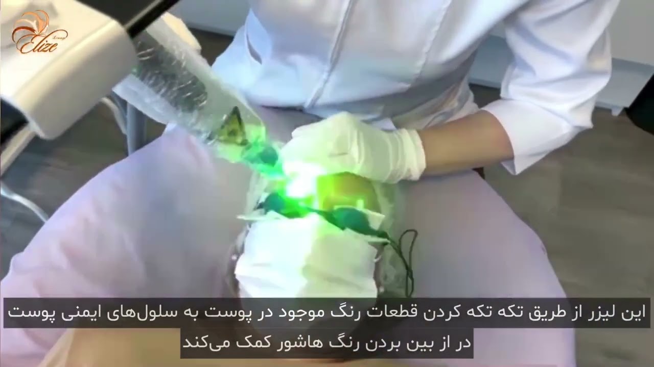 💠پاک کردن هاشور ابرو با لیزر