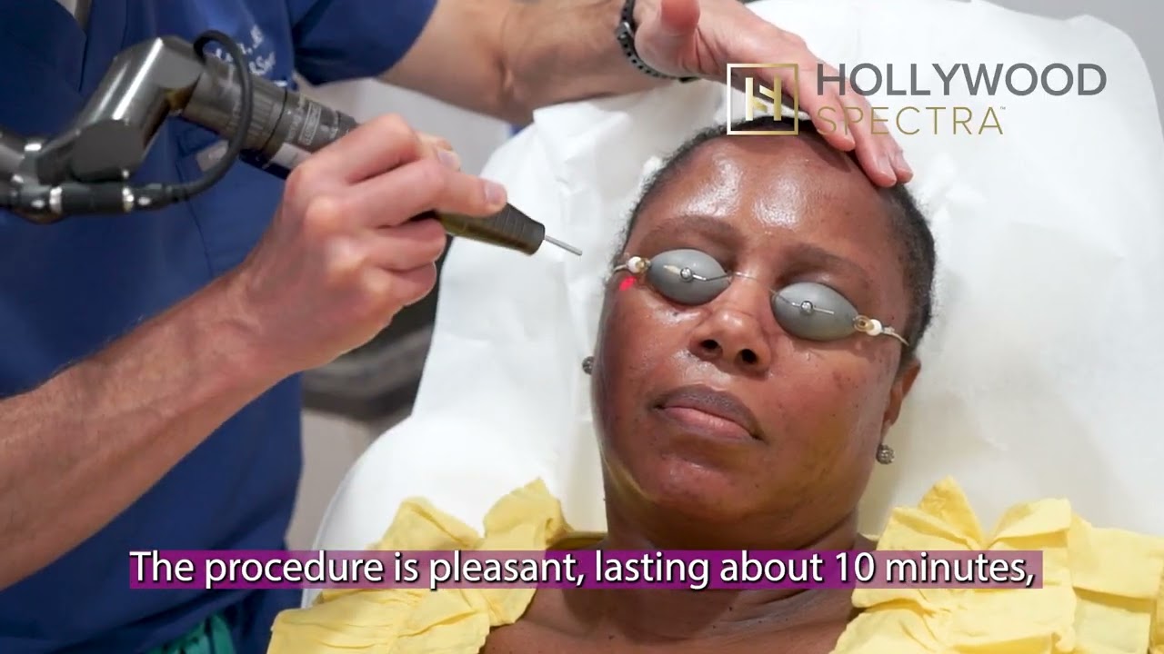 ✨ Hollywood Spectra Laser – The Ultimate Skin Rejuvenation ✨