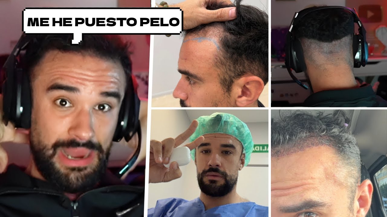 Illojuan Cuenta Que Se Ha Puesto Pelo Y Explica Su Operacion