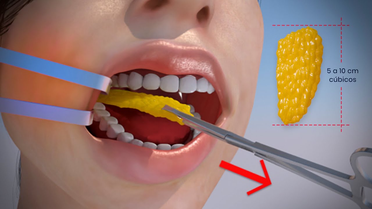 Así es el proceso de la bichectomía ¿Vale la pena?