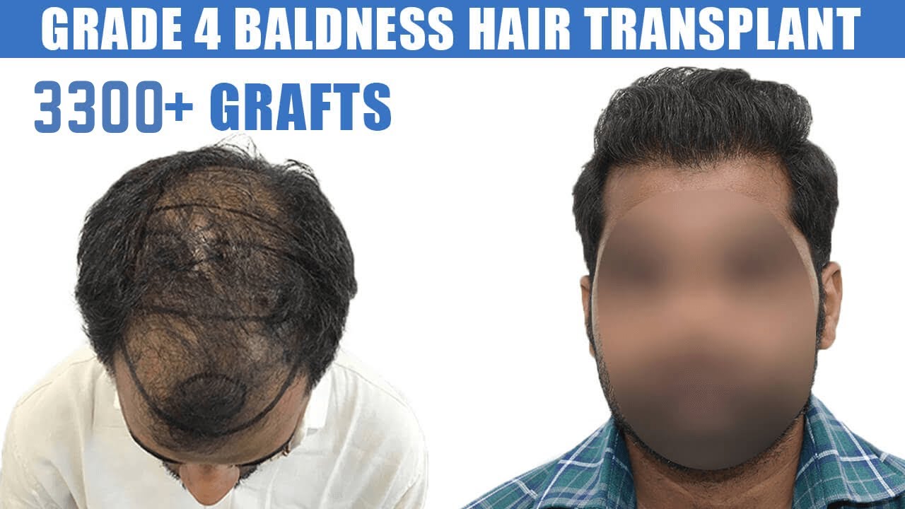 Grade 4 Baldness Hair Transplant Result (In 8 Months) || 3300+ Grafts || Hairfree Hairgrow Clinic