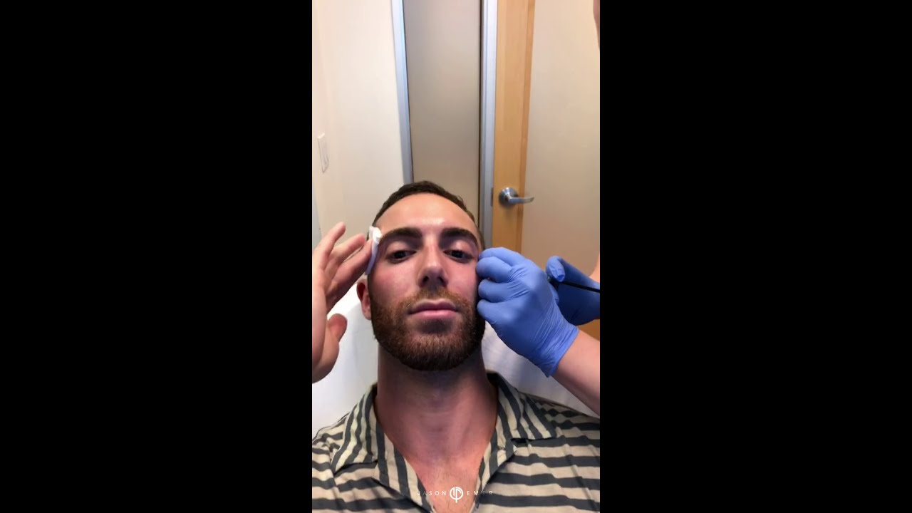 Chin, Jaw and Temple Augmentation with Fillers | Male Facial Sculpting | Live