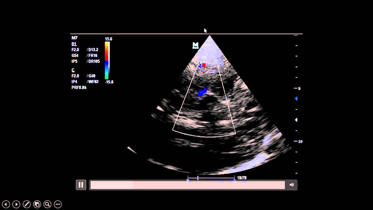 the complete story [How to do transcranial doppler step by step approach]