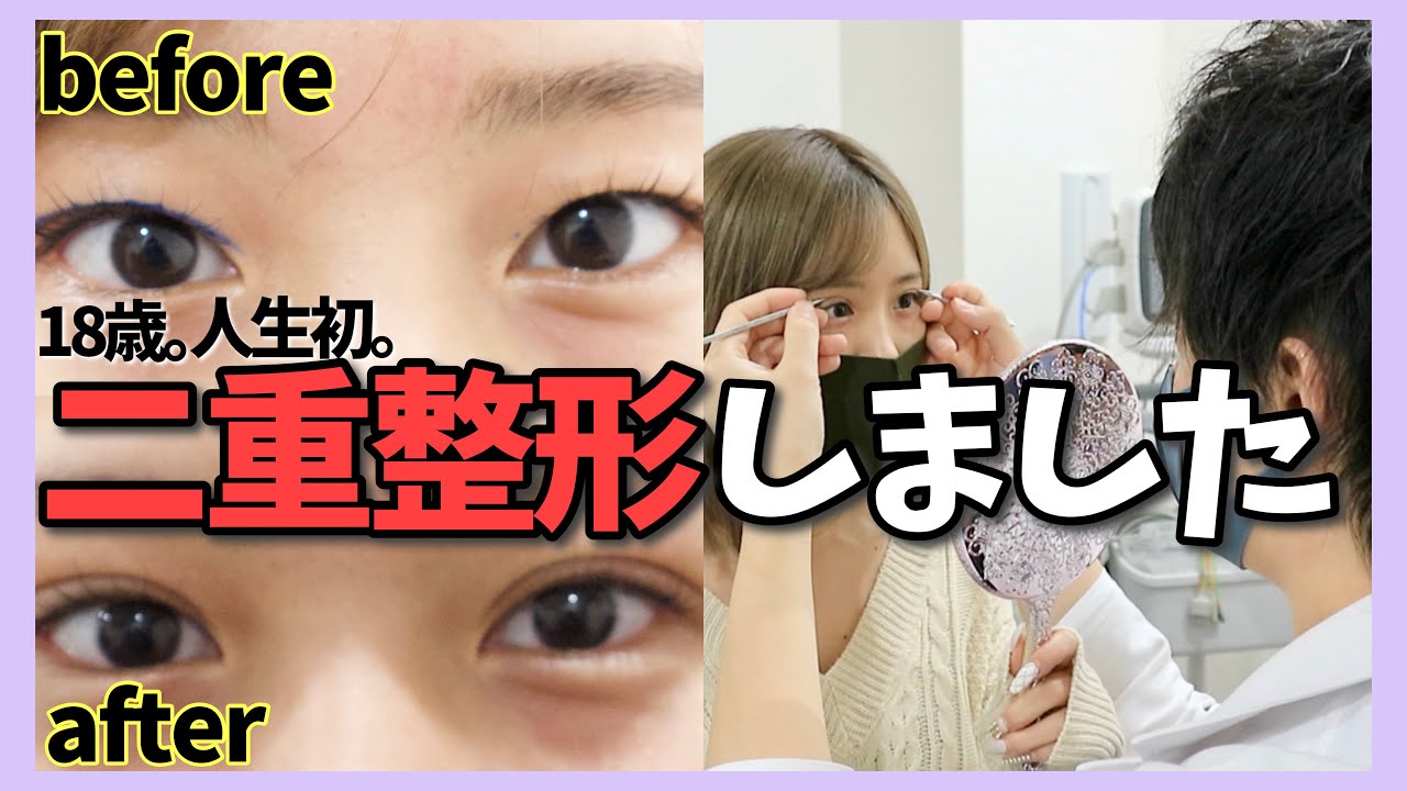 【二重整形】奥二重からついに念願の二重に！！！【密着】