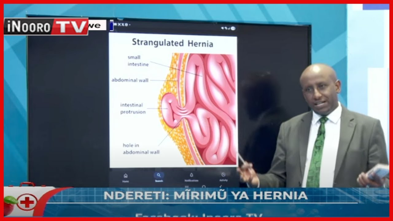 Mĩrimũ ya Hernia #ŨriaNdagĩtarĩ