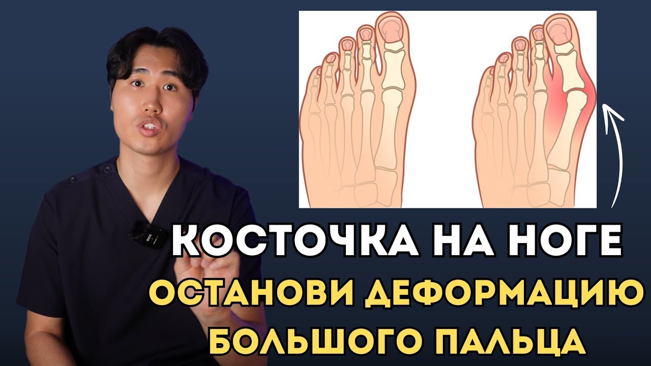 Косточка на большом пальце. Вылечи эти мышцы и останови деформацию большого пальца стопы.