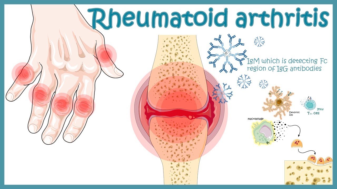 Rheumatoid Arthritis | autoimmune disorder | Pathophysiology, risk factors ,treatment.