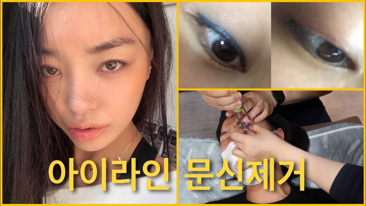 12년된 쇼니의 아이라인 문신제거 시술풀영상 & QnA