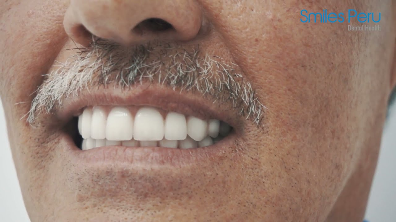 Implante Dental Peru | Pr&oacute;tesis sobre Implantes Dentales | Smiles Peru