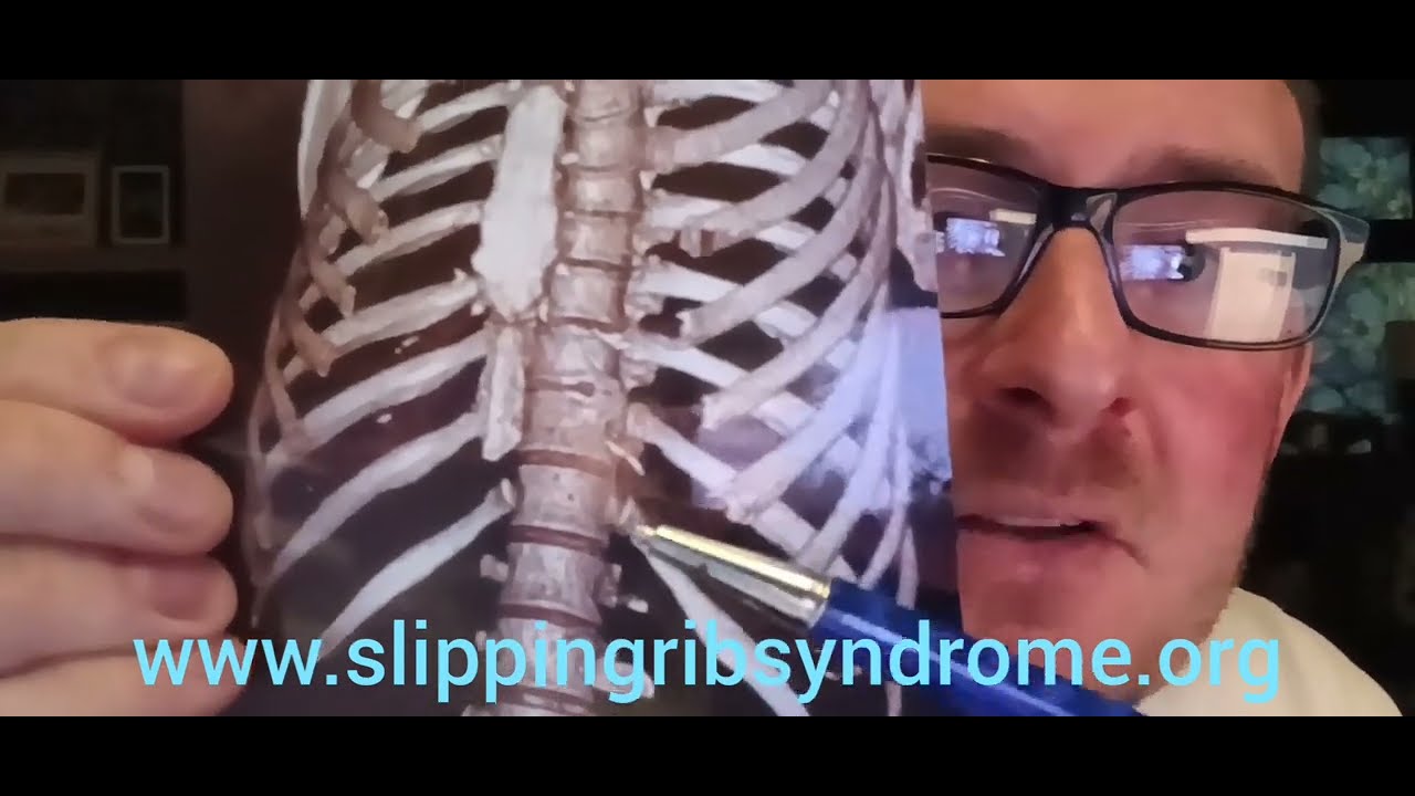 Rib Head Syndrome (Subluxation / Disarticulation at the Costotransverse / Costovertebral Joint)
