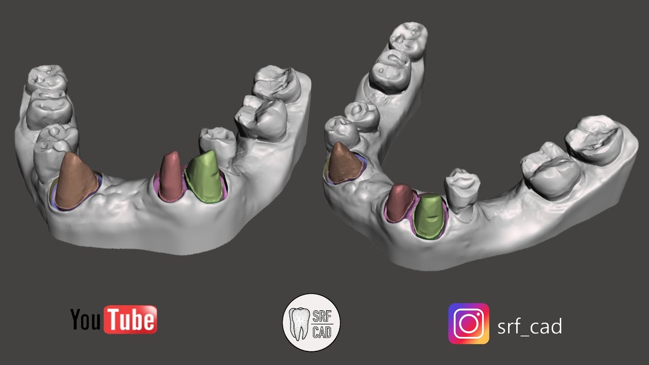 MESHMIXER DENTAL COME CREARE UN DITCHING SU MODELLO DA IMPRONTA INTRAORALE DIE