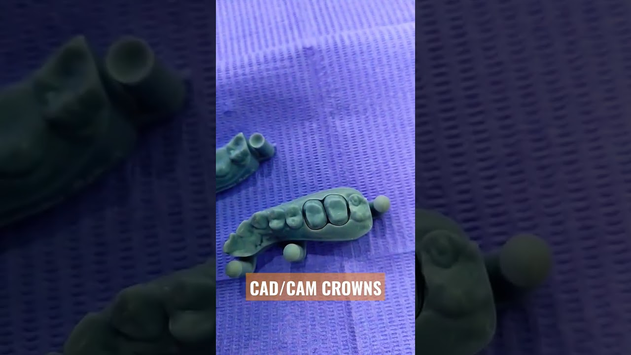 DMLS and CAD CAM crowns #shorts