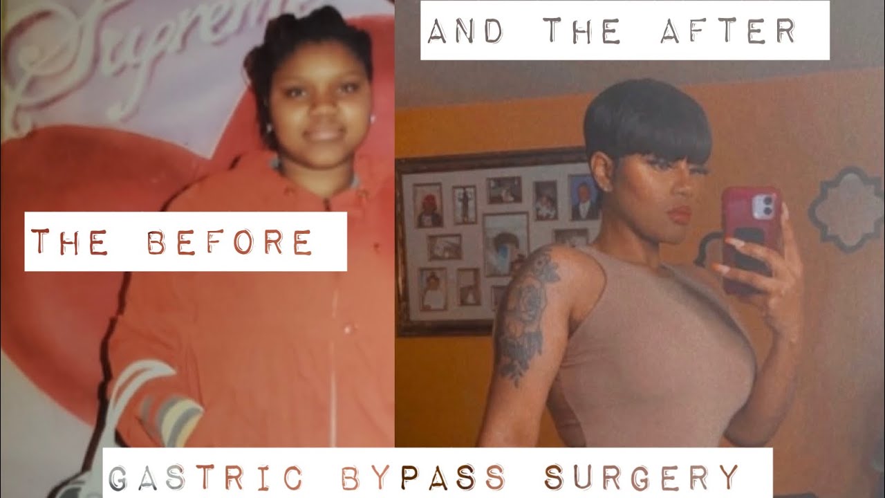Pro’s And Con’s About Gastric Bypass Surgery~ And The Surgery Process