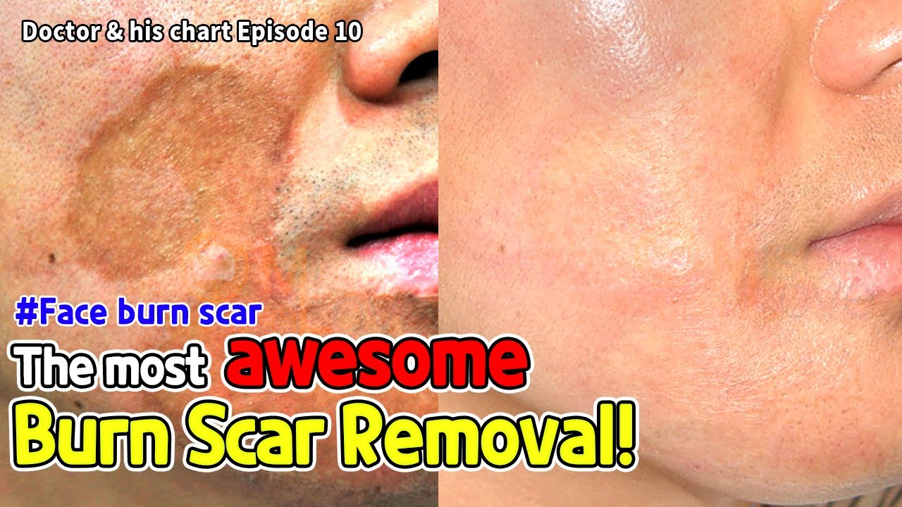 ［Scar clinic in korea］face burn scar the most awesome burn scar removal