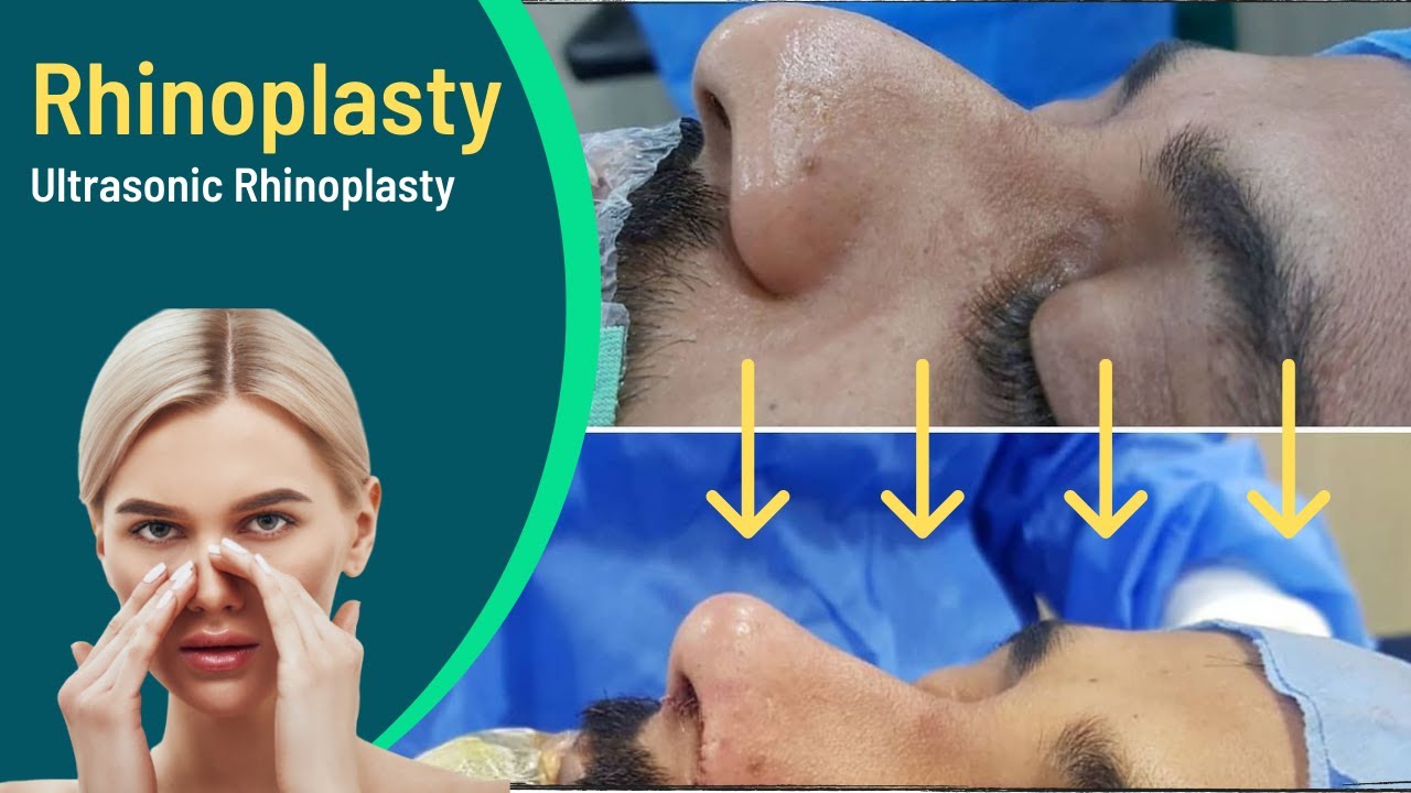 Rhinoplasty surgery (Nose Job) | Ultrasonic Rhinoplasty | Best plastic surgeon in Lahore