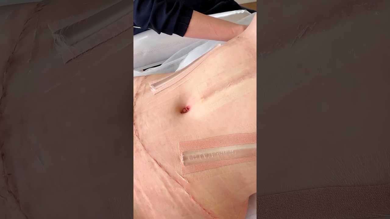 Cirurgia Pl&aacute;stica: a cicatriz da Abdominoplastia fica invis&iacute;vel? #cirurgiaplastica