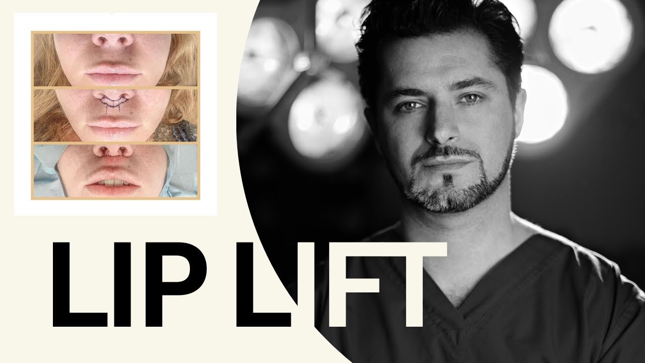 Lip Lift - Lifting wargi g&oacute;rnej - OT.CO Clinic