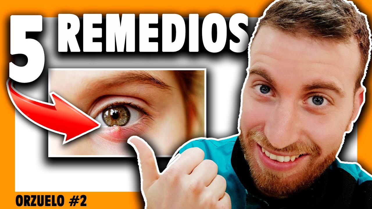 🔶 ¿Cómo CURAR el ORZUELO en el ojo? Y una recomendación importante...
