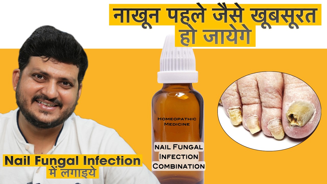 Nail Fungal Infection | Homeopathic Medicine Combination | @Drkirtivikramsingh