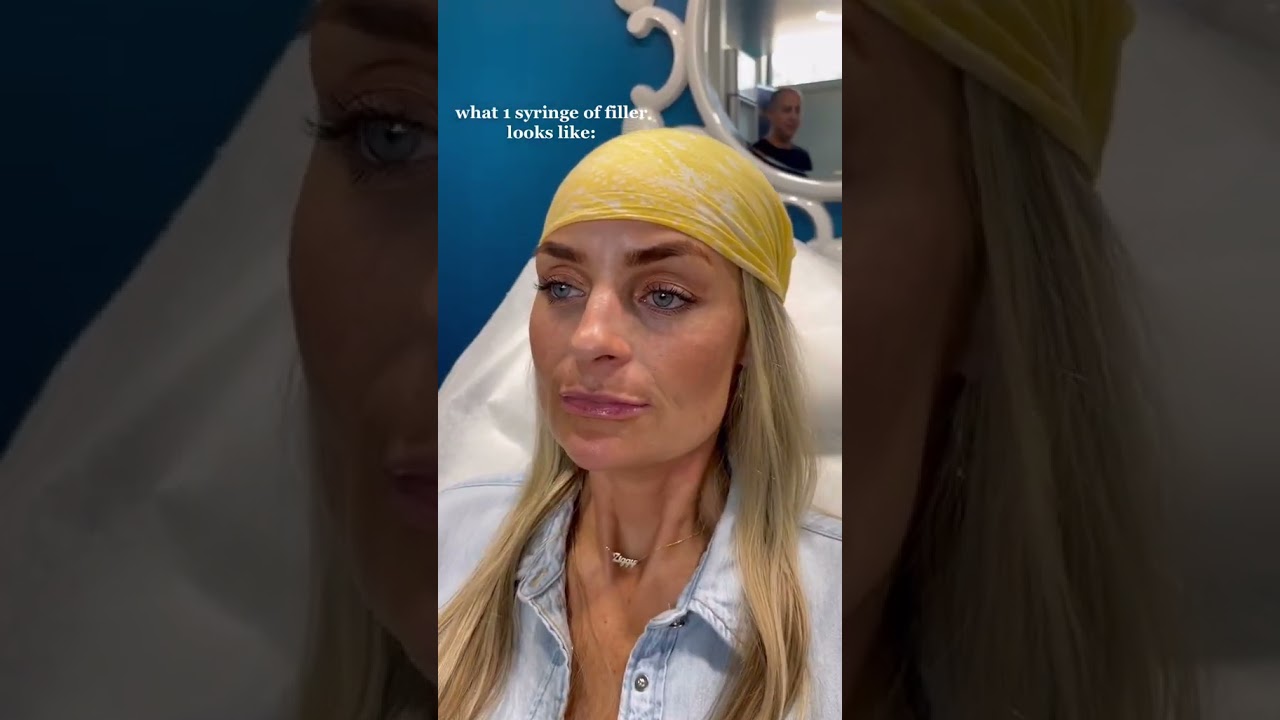 Watch This Before Getting Your First Filler Treatment! Palm Beach, Florida @Shorts #shorts