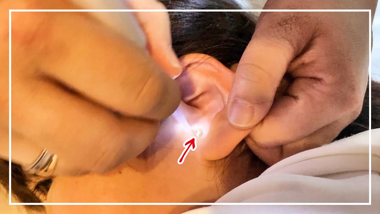 【耳かき】左耳が聞こえない？！見てみると岩石級の大物が……【閲覧注意】