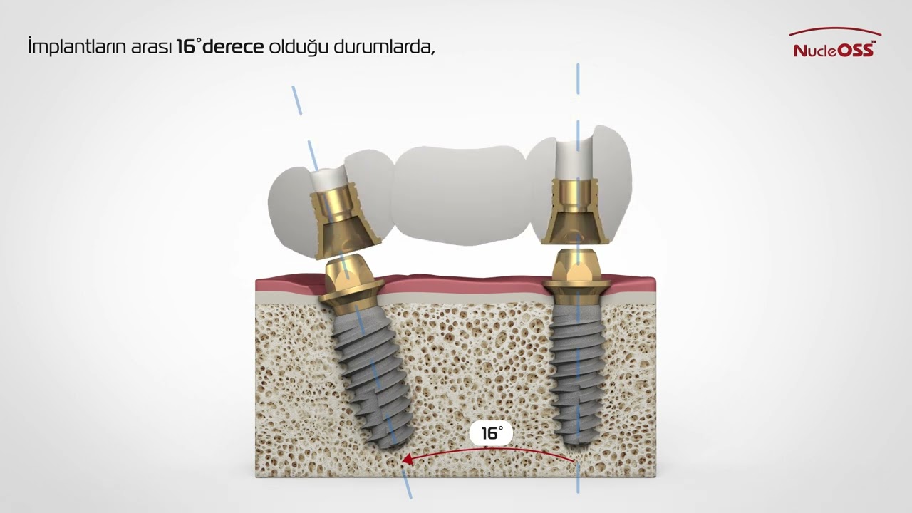 NucleOSS İmplantların Pozisyonları ve Dayanak Kullanımı