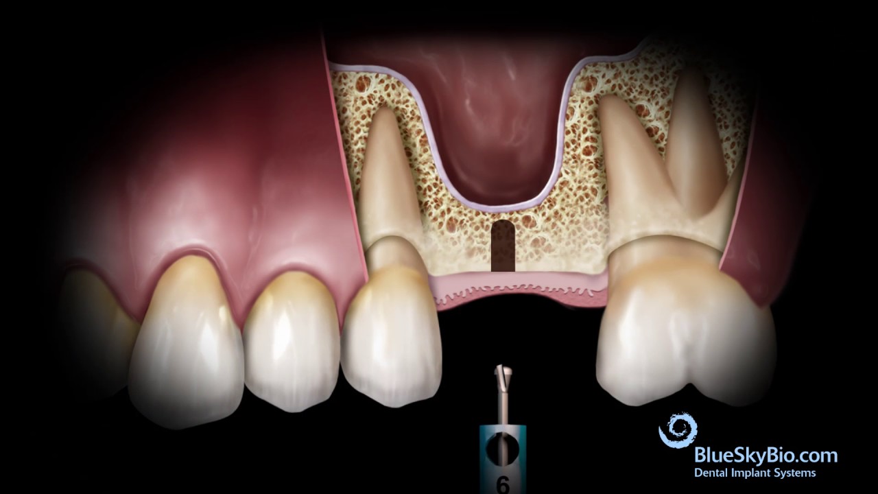 Basic Hammerless Sinus Lift Instrument&nbsp;Technique
