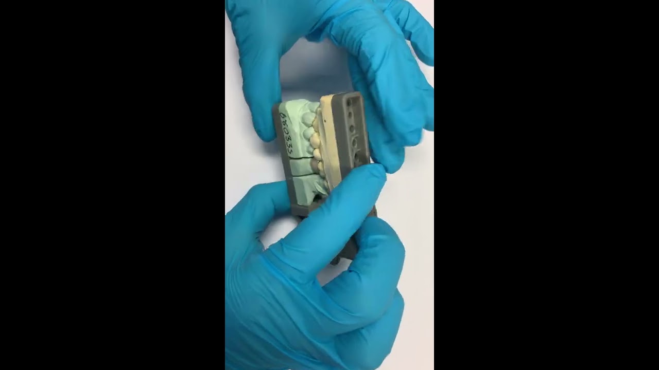 Disadvantages of using a triple tray impression technique