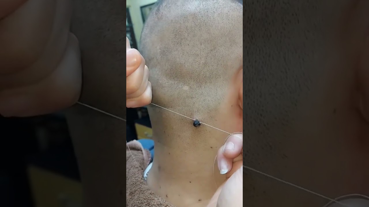 إزالة زوائد جلديه على فور