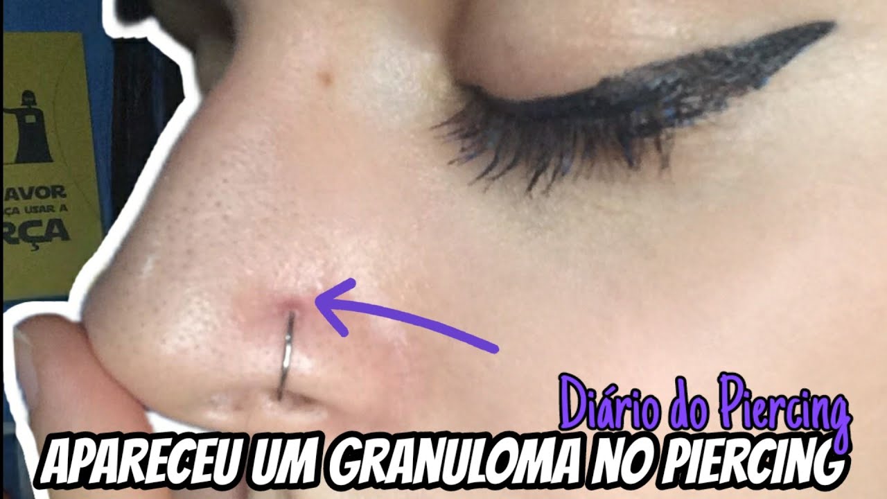 Apareceu um granuloma após 1 mês da perfuração no nariz!! - Diário do Piercing