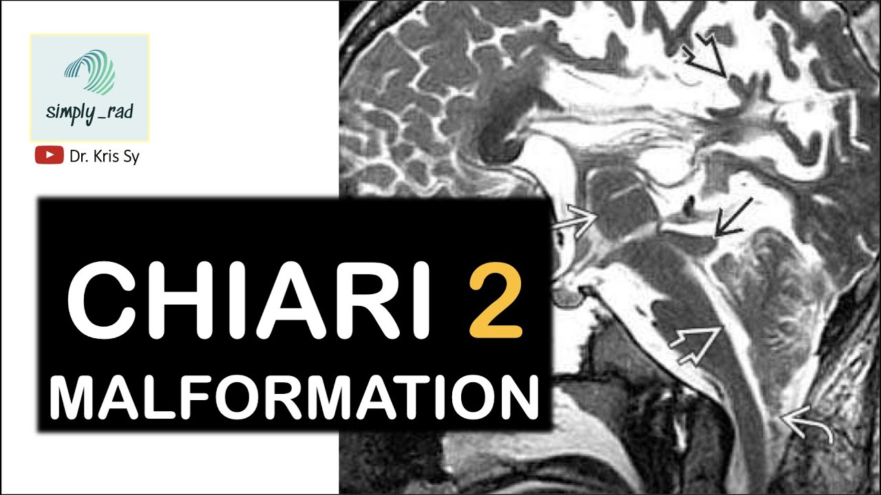 Chiari 2 malformation (MRI)