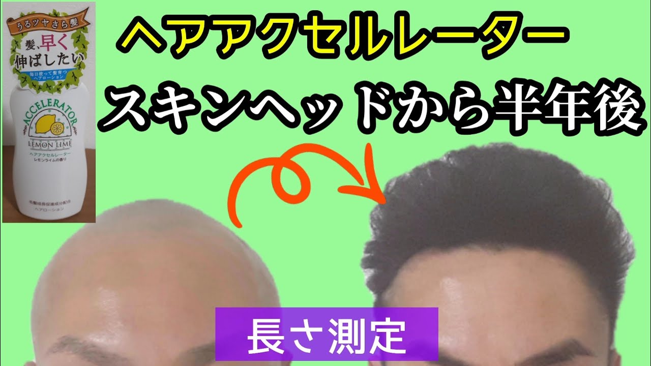 ヘアアクセルレーターをスキンヘッドから半年使用して○○cm伸びた！