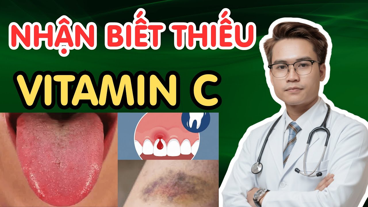 Осмотрите свой язык, чтобы распознать дефицит витамина С (как его восполнить) | Доктор Фам Туан