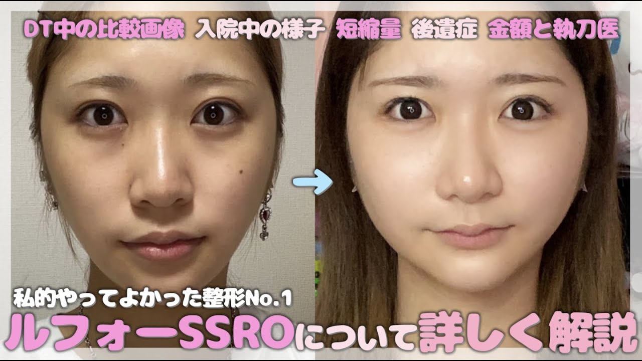 【両顎】私的やってよかった整形1位のルフォー SSROについて詳しく【質問解答】