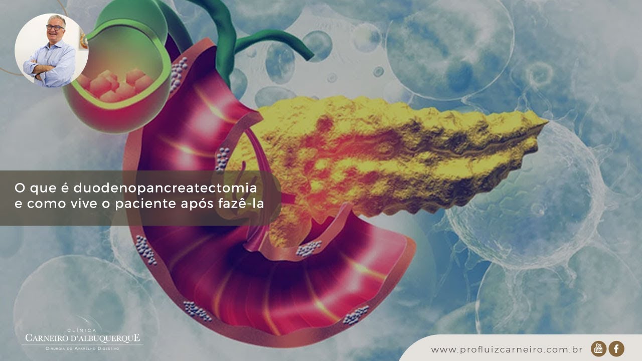O que é Duodenopancreatectomia e tipos de cirurgia | Prof. Dr. Luiz Carneiro CRM 22.761