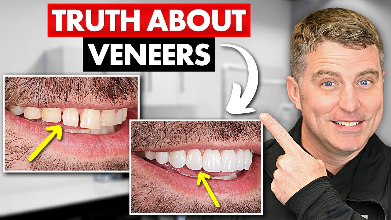 How To Get Perfect Veneers (That Instantly Upgrade Your Smile)