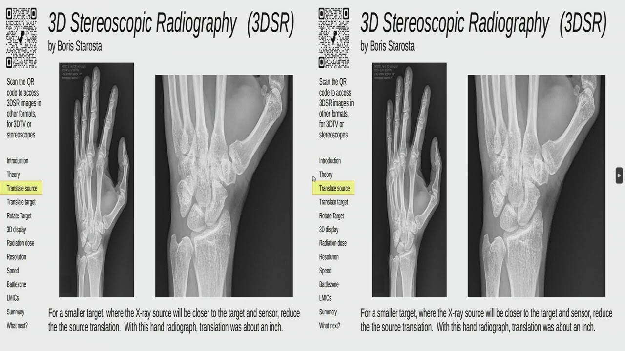 SD&A 2025: Stereoscopic radiography: New possibilities in the digital era using low cost … (3D)