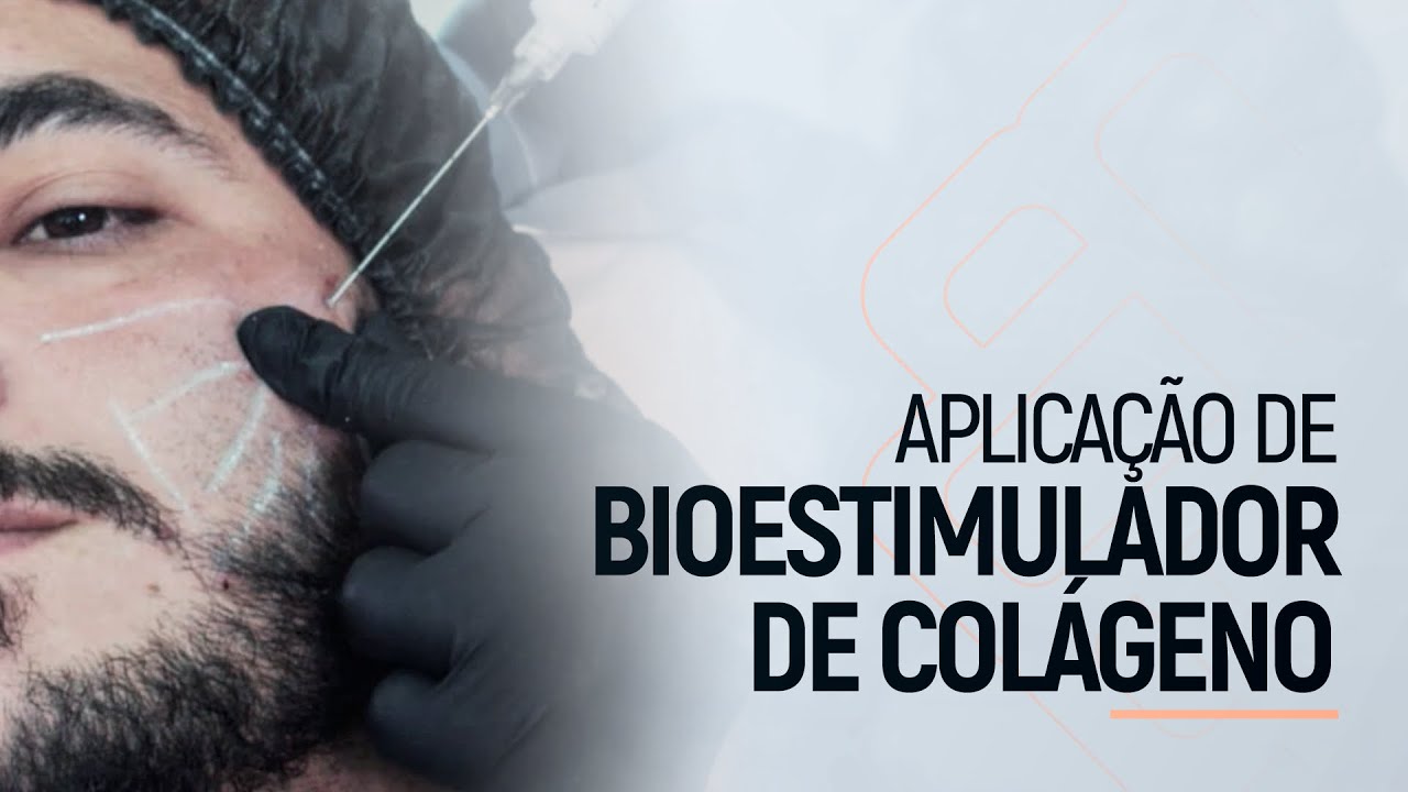 Aplicação de Bioestimulador de Colágeno | Efeito Lifting