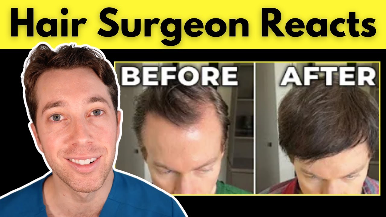 Bryan Johnson's Hair Loss | Hair Surgeon Reacts