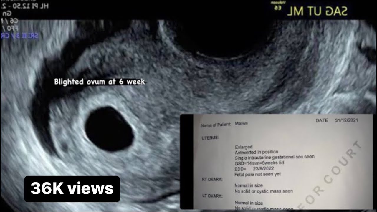 No fetal pole at 6th week ? In hindi /urdu