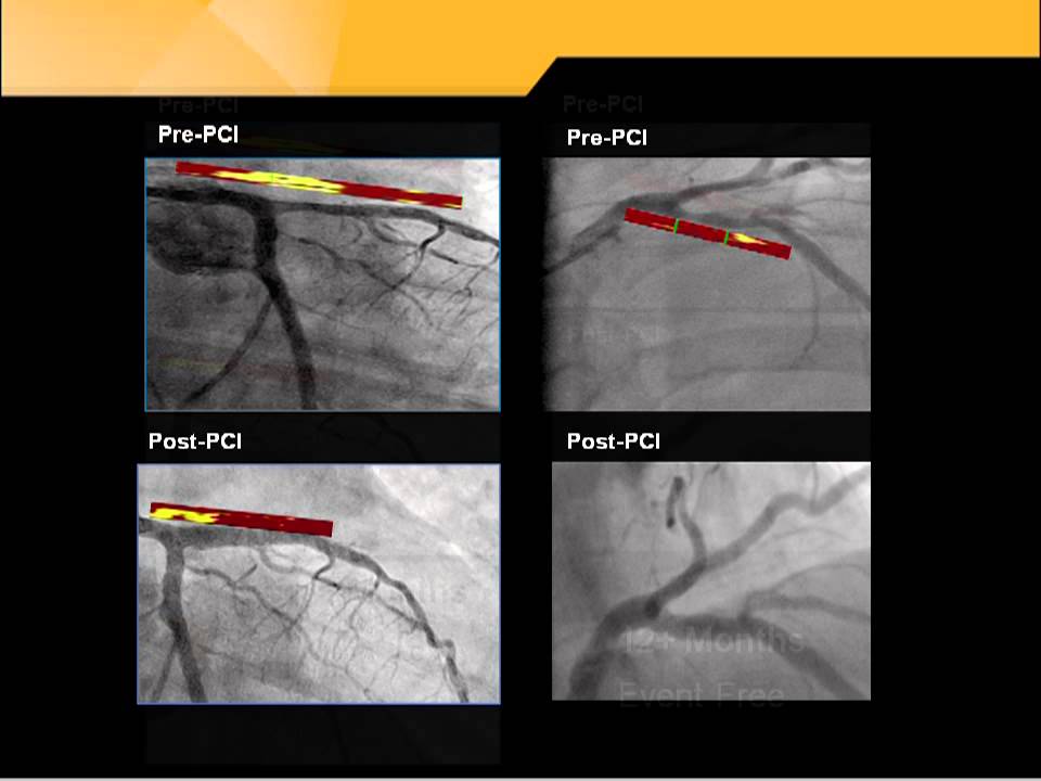 Detection of Lipid Core Plaque Differentiaties Patients with Similar Angiographic Results