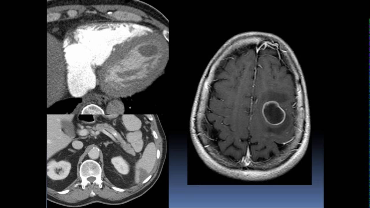 2016 AOCR Radiology Case Review: Cardiopulmonary - Common Diagnoses in HRCT