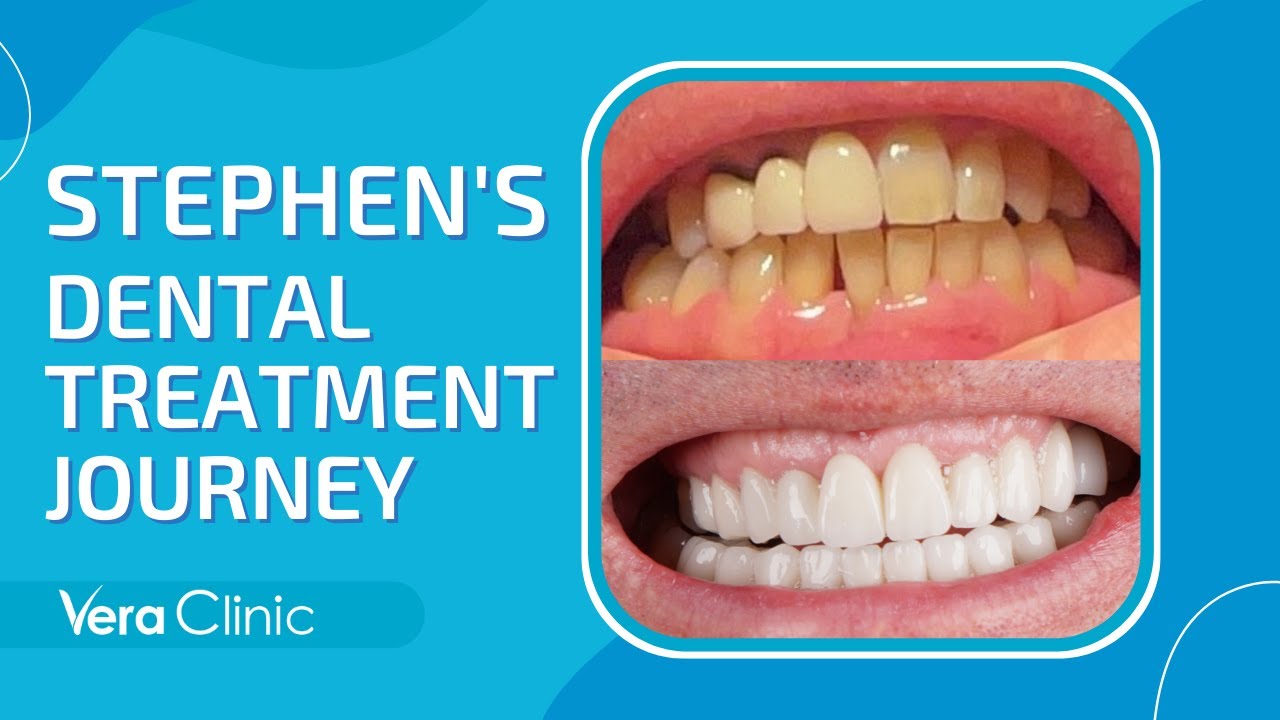 Dental Treatment Journey: Stephen's Experience in Vera Clinic