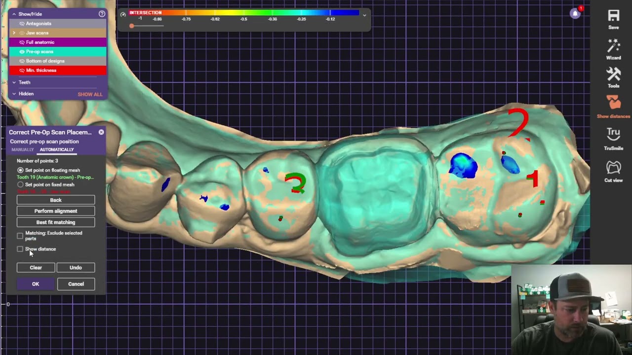 Complete Guide: Copying Pre-Op Scans for Perfect Nightguard & Retainer Fit on New Crowns in Exocad